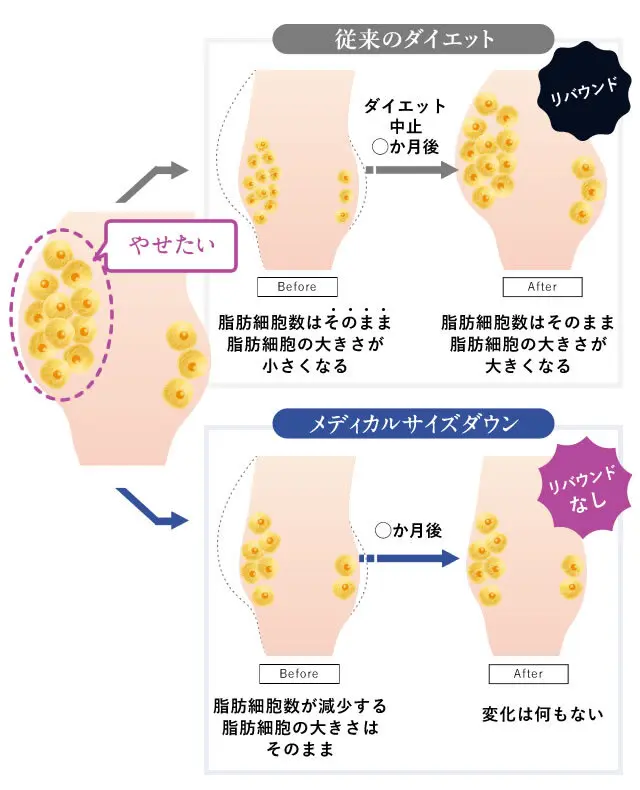 脂肪吸引をすることで脂肪細胞の数が減る。